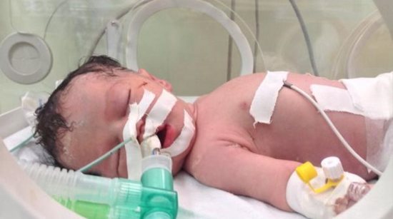 Γάζα: Πέθανε το μωρό-θαύμα που είχε γεννηθεί από νεκρή μητέρα